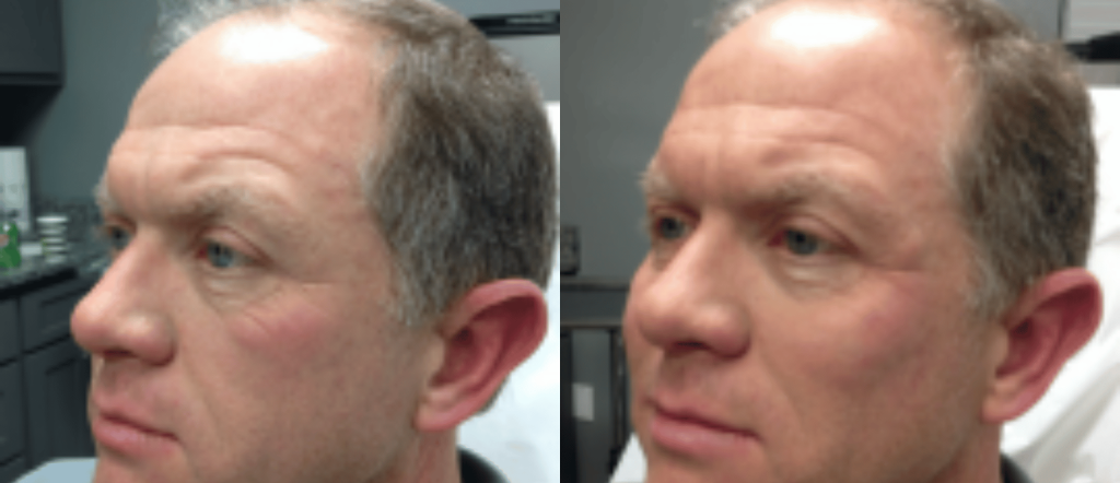 Before and After Dermal Fillers "Liquid Facelift"