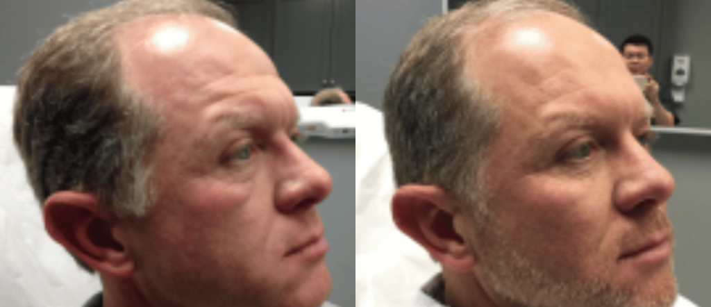 Before and After Dermal Fillers "Liquid Facelift"