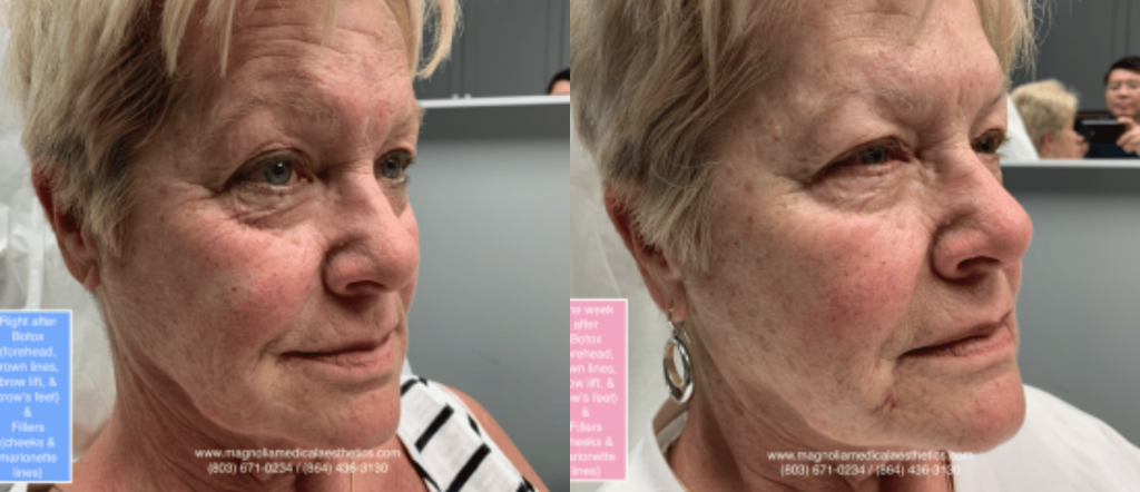 Before and After Dermal Fillers "Liquid Facelift"