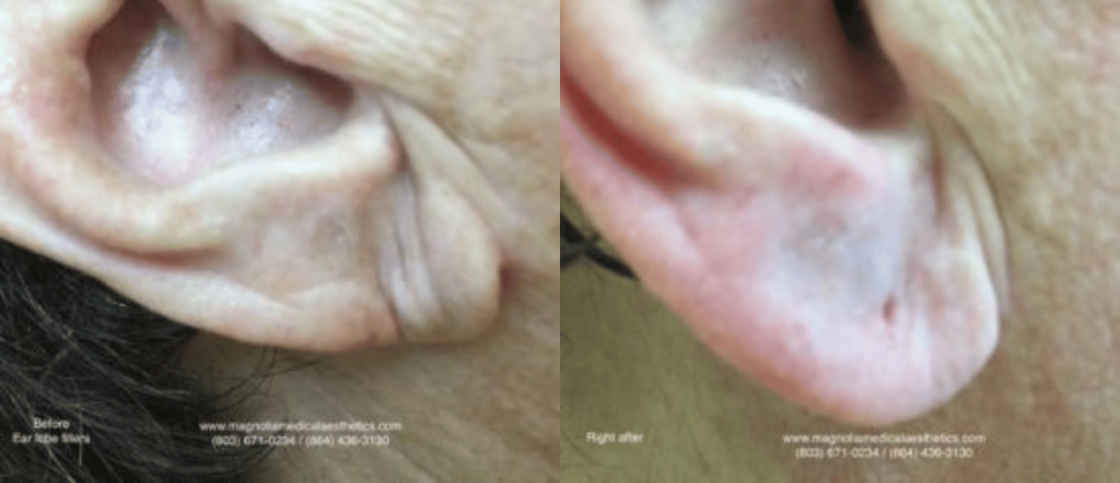 Before and After Dermal Fillers on Earlobe