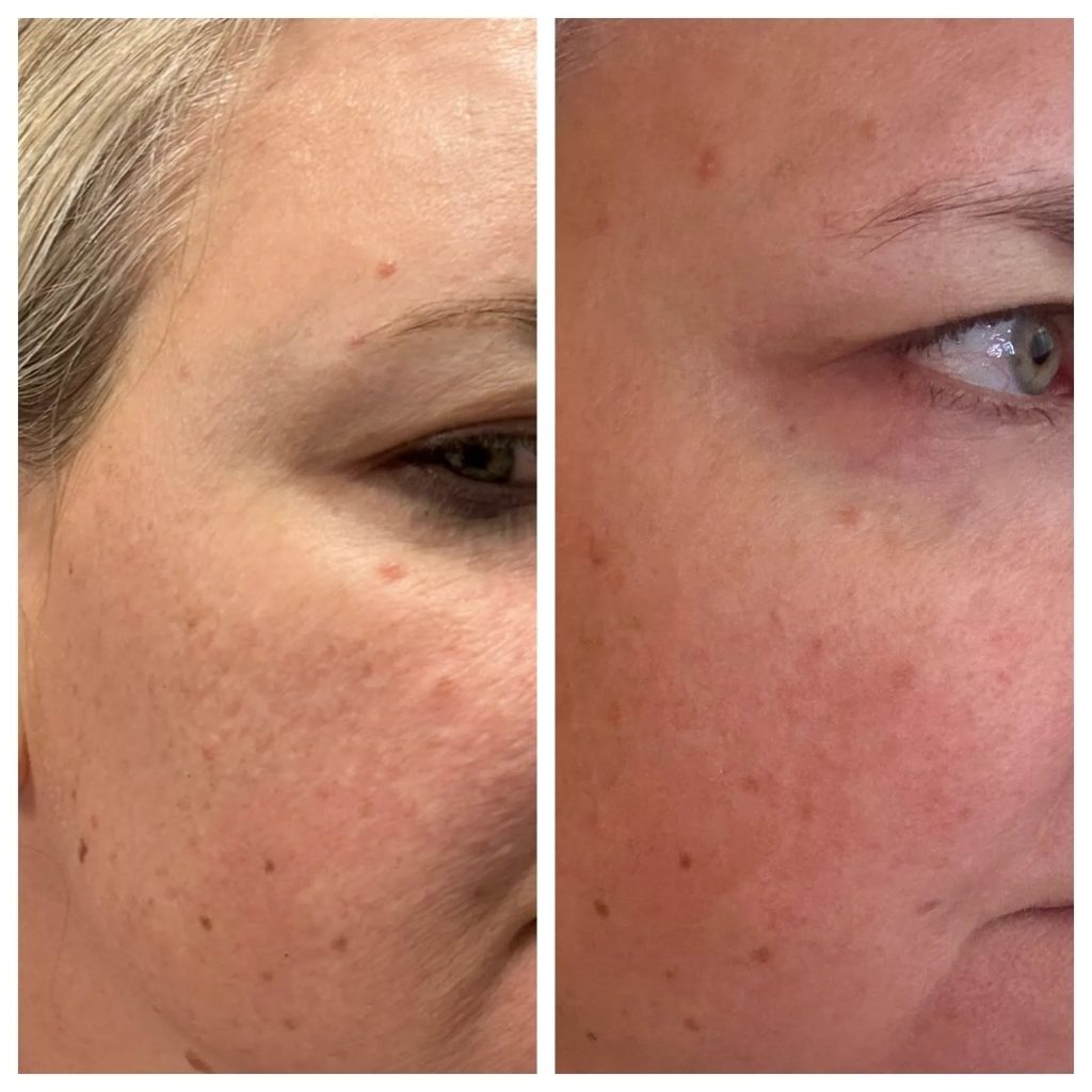 CO2 Results at Magnolia Medical