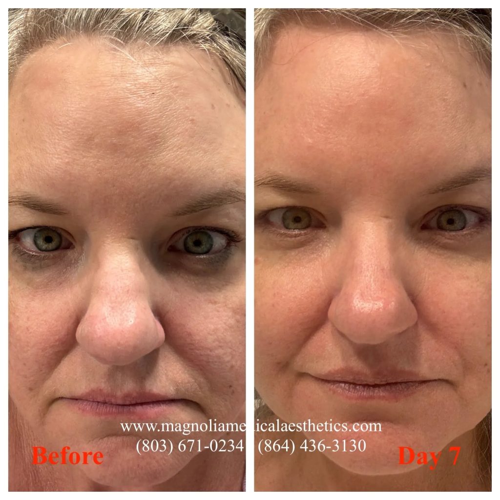 CO2 Results at Magnolia Medical