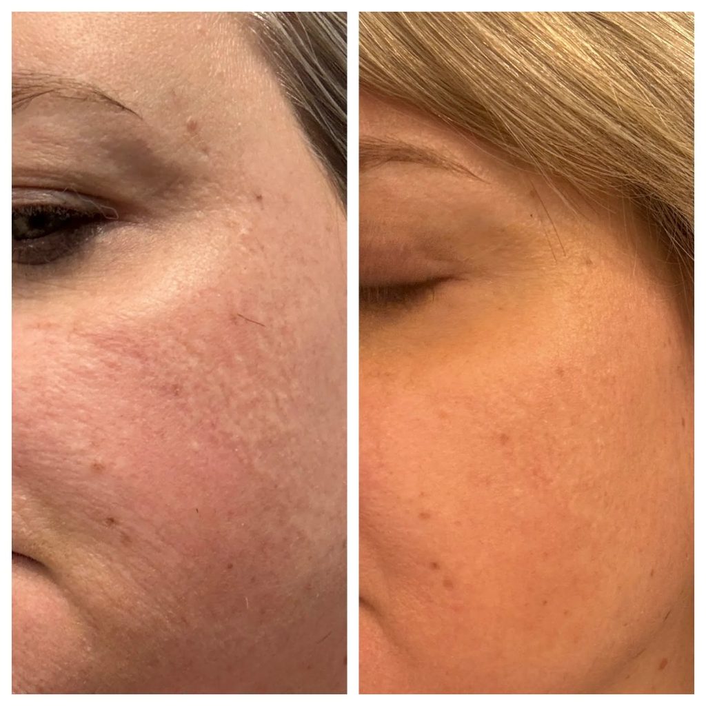 CO2 Results at Magnolia Medical